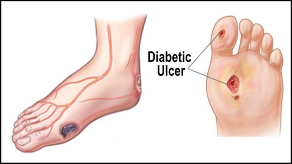 Diabetic Foot Ulcers and Hyperbaric Oxygen Therapy - Hyperbaric Store